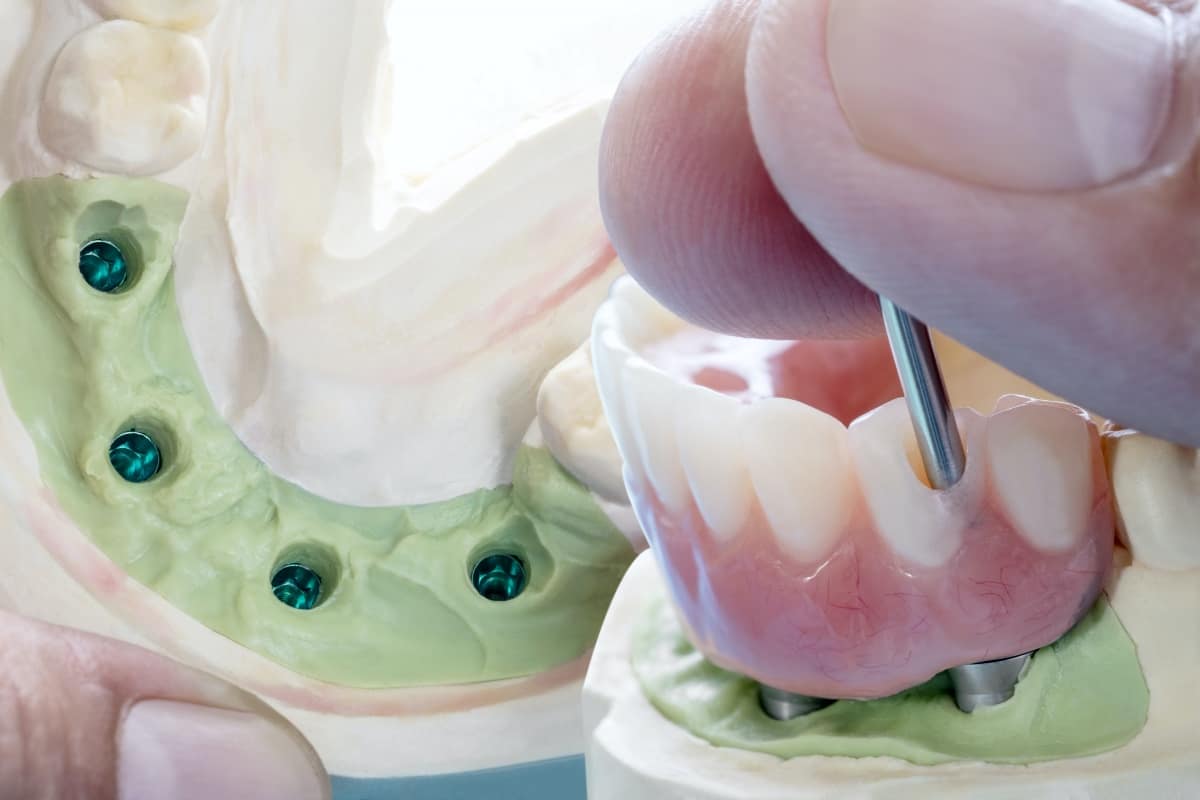 All On Four dental Bridges