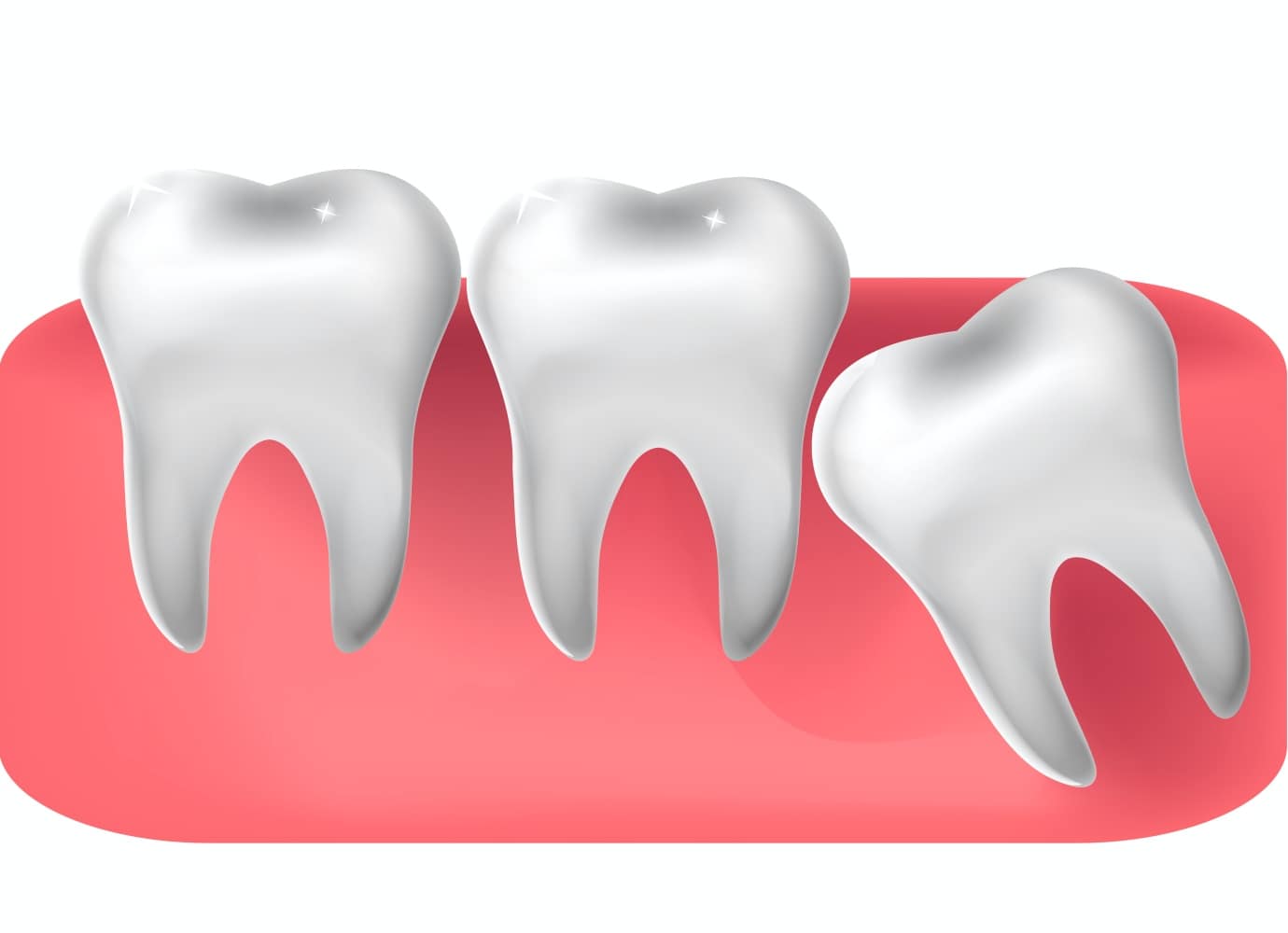 Wisdom Teeth Removal