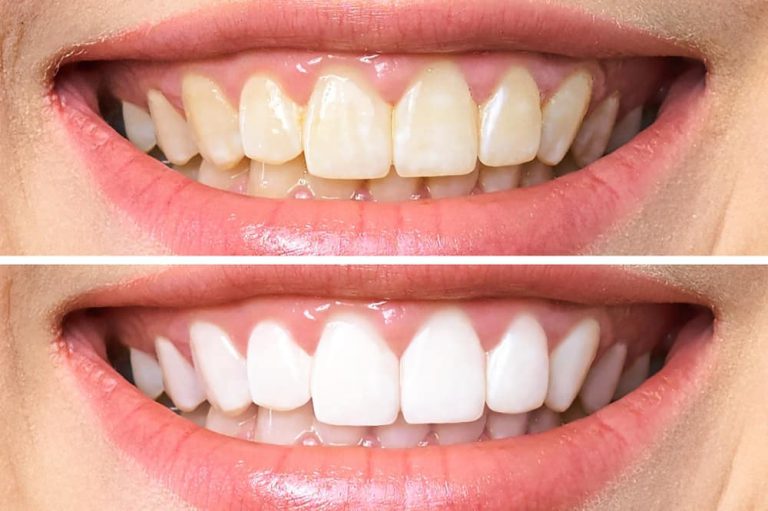 Cosmetic Dentistry In Toronto