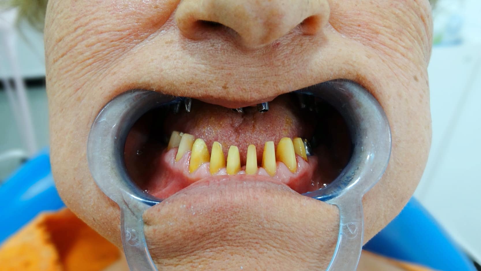 Dental Treatments in Turkey