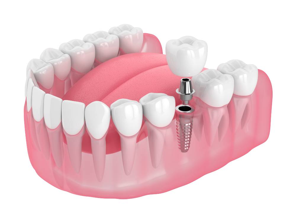 3d render of jaw with dental implant isolated