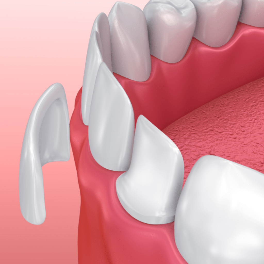 How Much for a Full Set of Dental Veneers in Turkey?