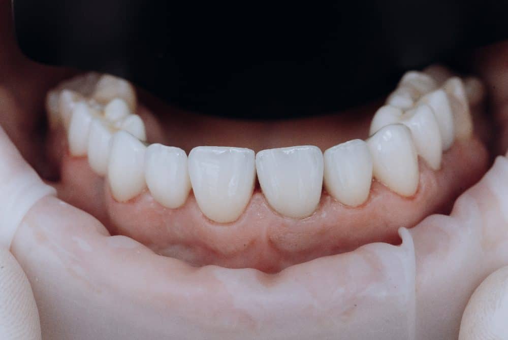 zirconium crowns in turkey