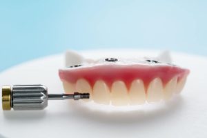 zygomatic implants in turkey