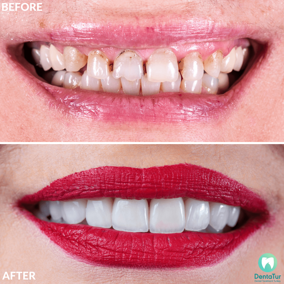 Dental crowns in Turkey Cost, Zirconium, Porcelain, EMax