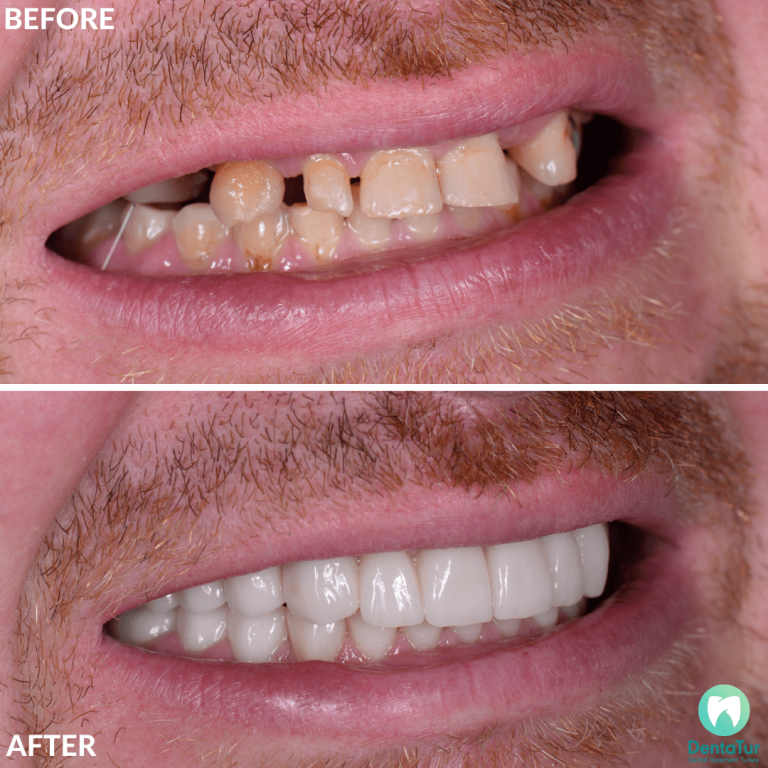 Dental crowns in Turkey Cost, Zirconium, Porcelain, EMax