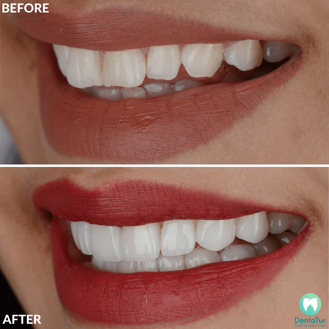 Dental Veneers in Turkey Before and After