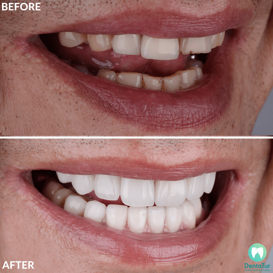 The Cost of Getting Veneers in Turkey Dentatur