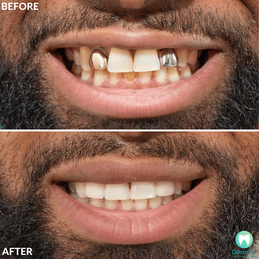 How much to get teeth done in Turkey and where can i get it?