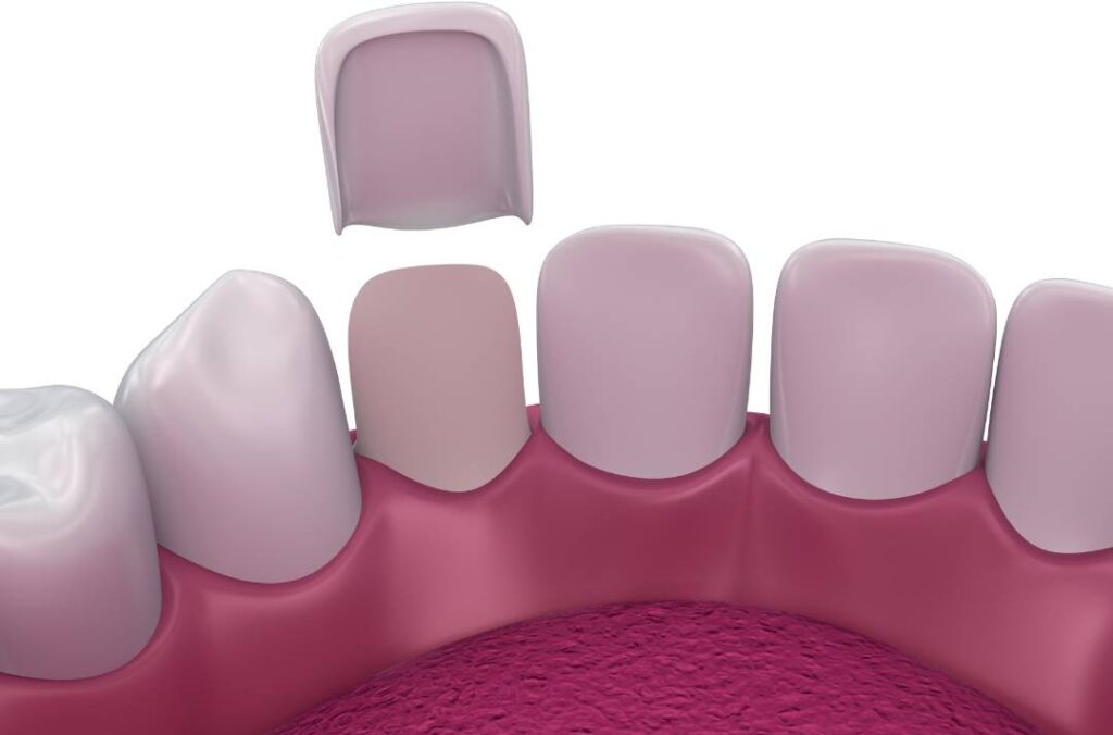 The cheapest country to get dental work done Turkey