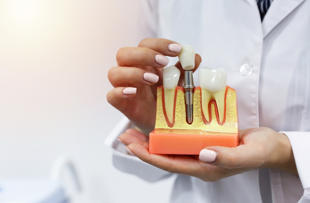 best dental implants in turkey