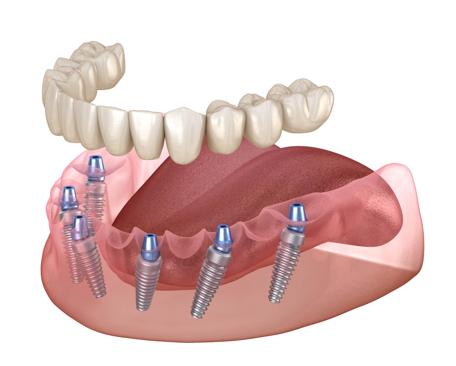 All-on-6 Dental Implants Cost in Turkey