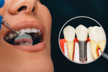 dental implants