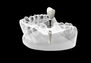 zirconium crowns