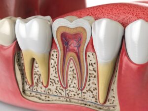 Root canal treatment