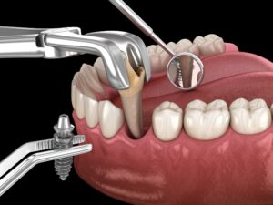 dental implants in turkey