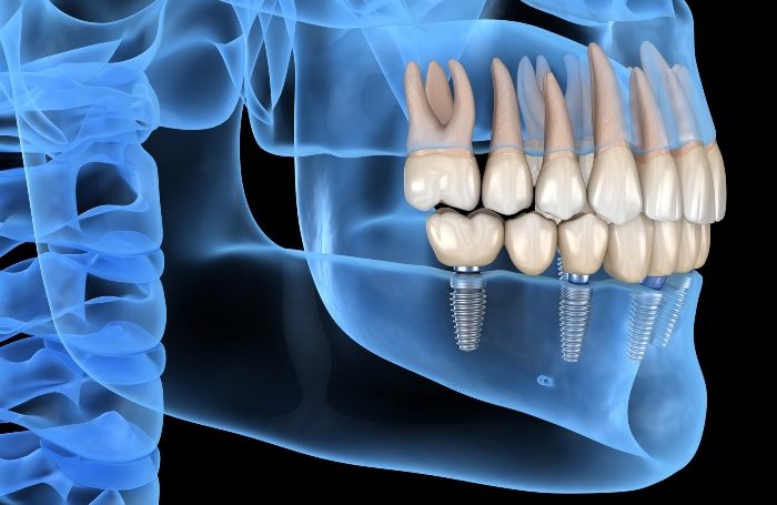 full mouth dental implants