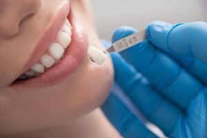 Types of Dental Veneers in Turkey