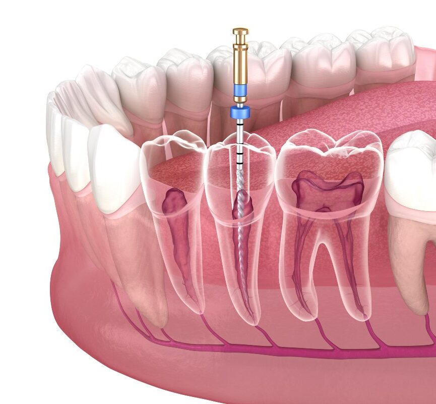 Cost of Root Canal Treatment in Turkey