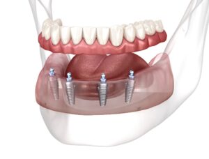 All-on-4 Dental Implantation in Turkey