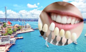 No-Prep Veneers Cost in Turkey