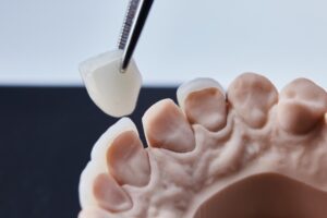 Price of Veneers in Turkey