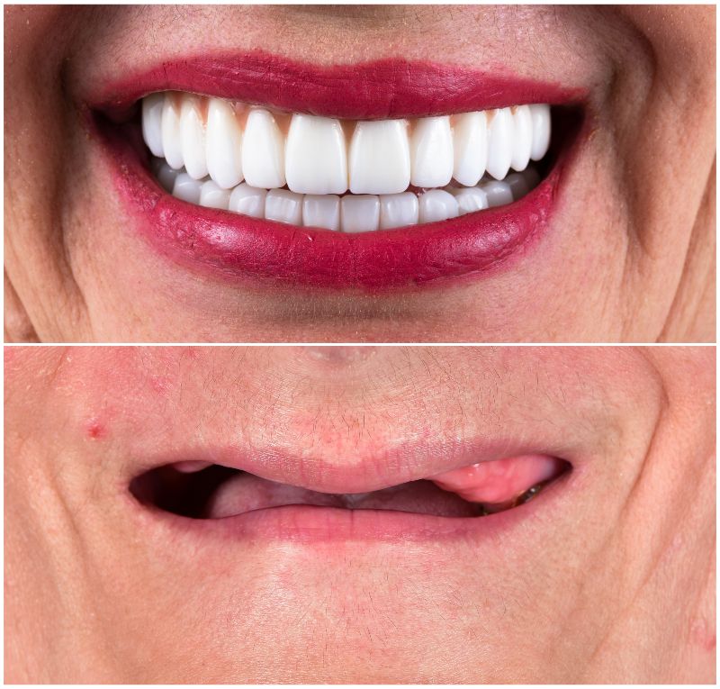 Full-Mouth Dental Implant Cost in Turkey