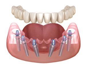All-on-6 Dental Implants in Turkey Prices and Reviews