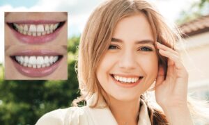 Zirconium Veneers Price in Turkey