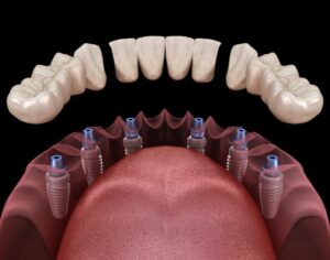 3-on-6 Dental Implants in Turkey