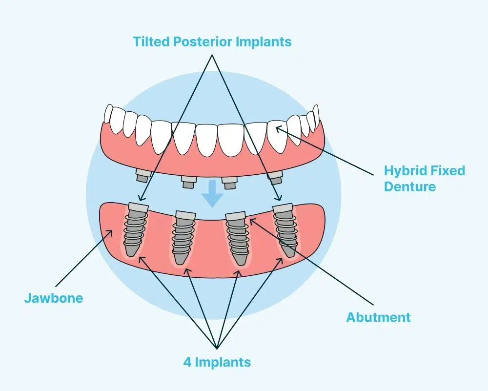 All-on-4 dental implants in Antalya