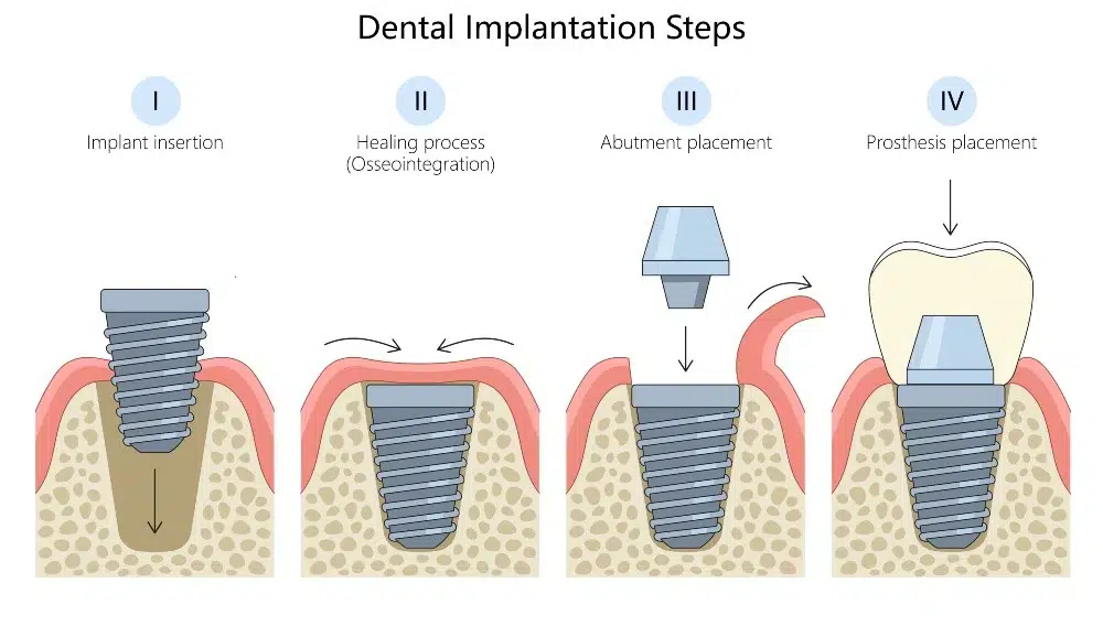 Dental Implant Process
