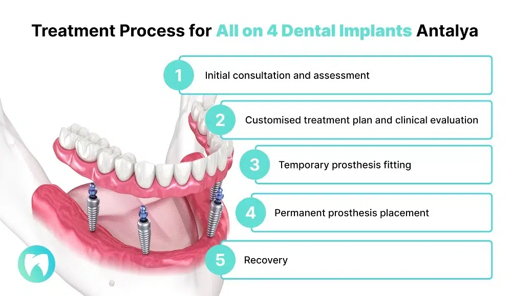 All-on-4 dental implants Treatment Process