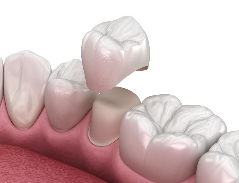 Zirconium Crowns in Turkey