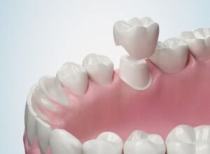 E-Max Crowns