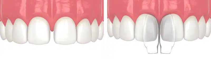 Composite Bonding Turkey