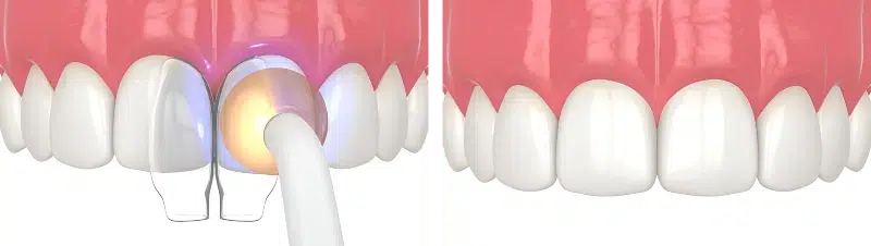 Composite Bonding Process