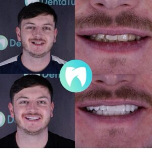 Dental Implants in Antalya