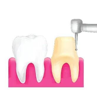 How are Dental Crowns made
