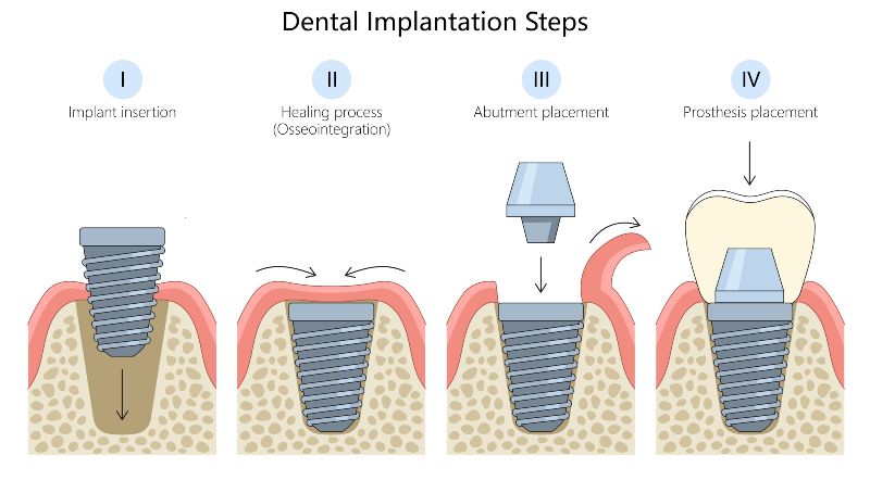 Dental implantation steps infographic