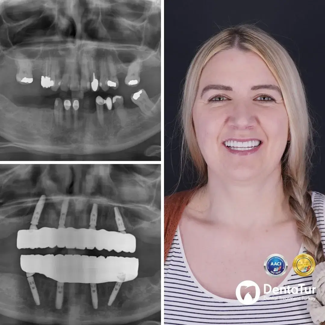 Full Mouth Dental Implants