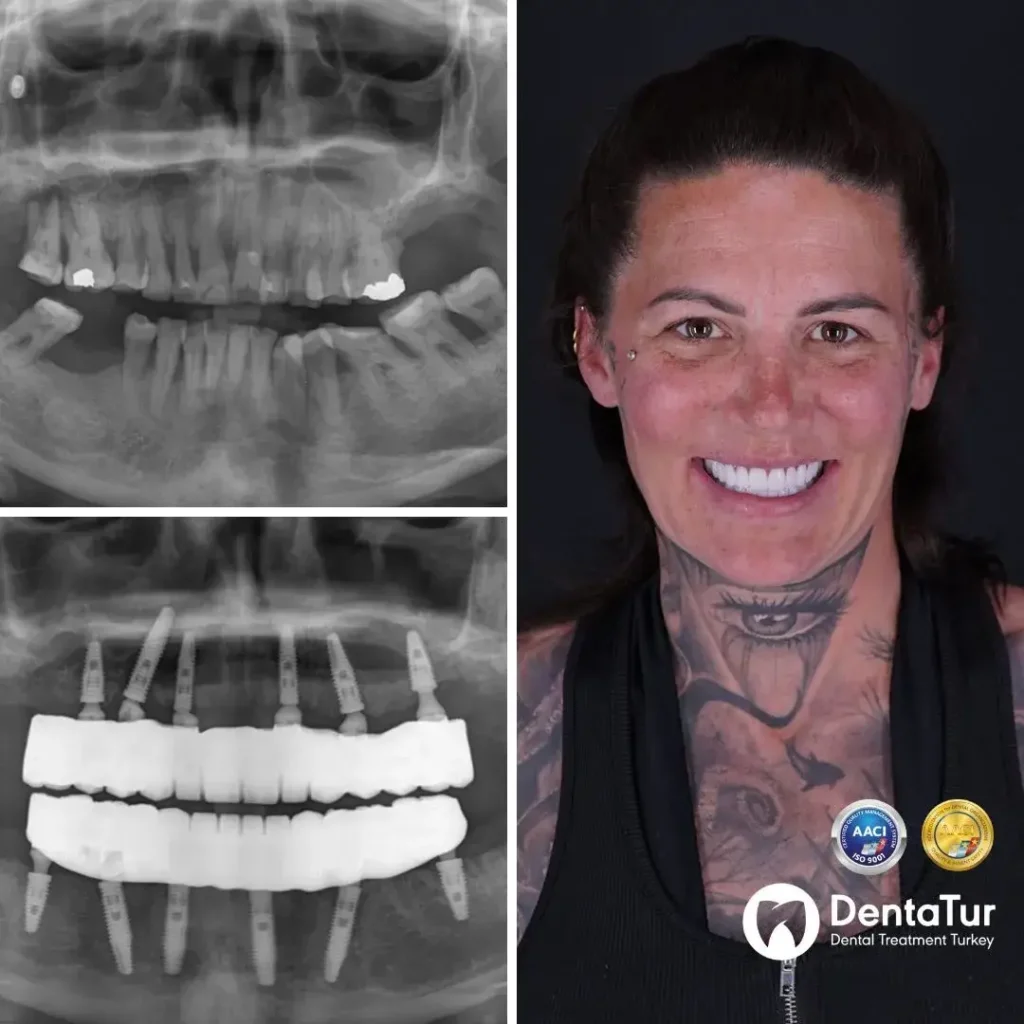 Full Mouth Dental Implants
