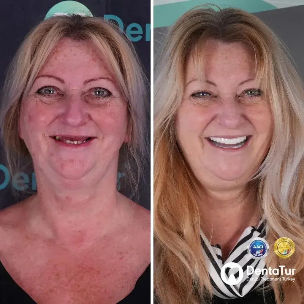 Full Mouth Dental Implants before and after