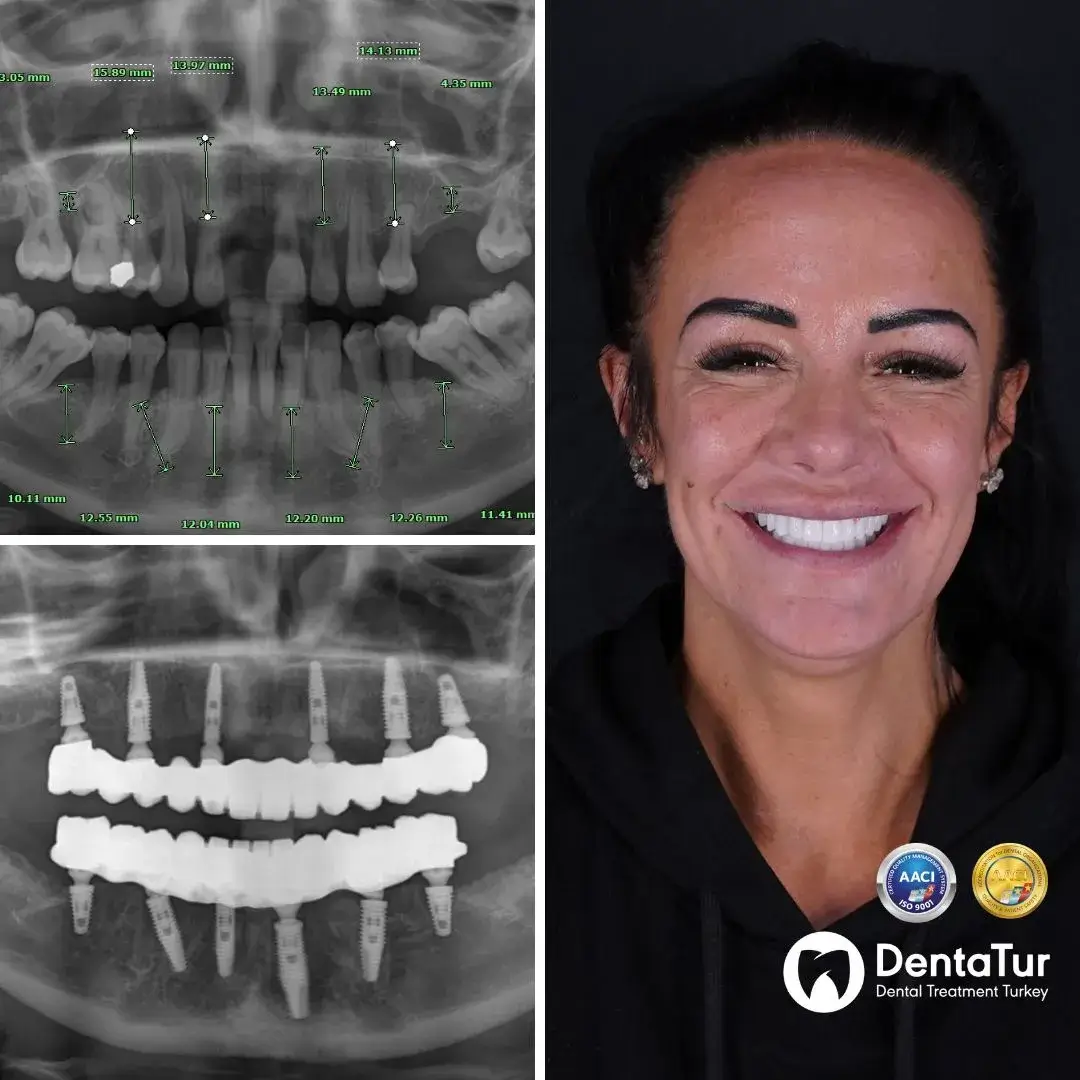 Full Mouth Dental Implants