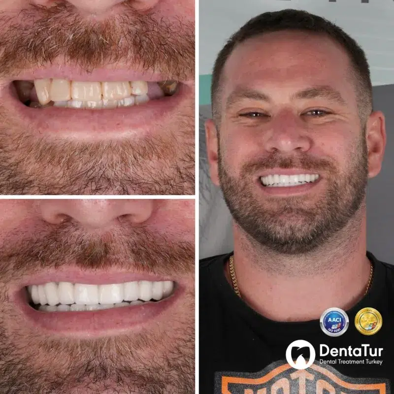 Porcelain Crowns