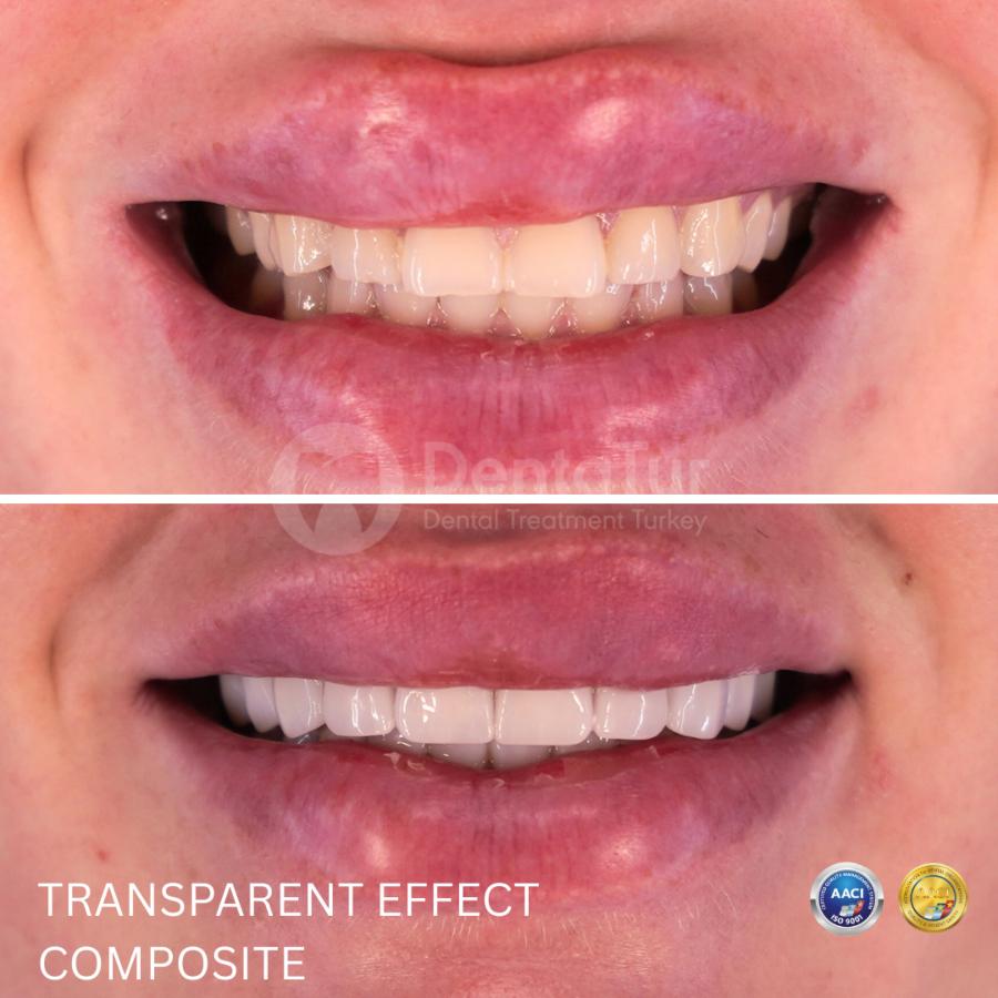 Composite Bonding (Veneers) in Turkey: Before and After Results