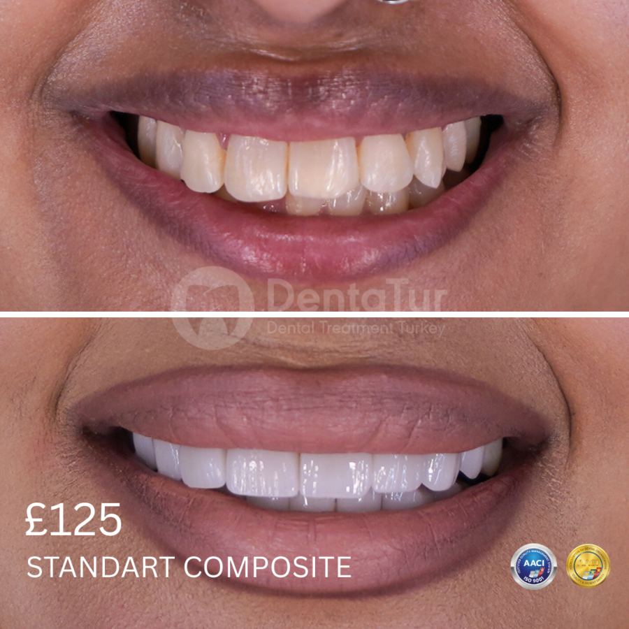 Composite Bonding (Veneers) in Turkey: Before and After Results