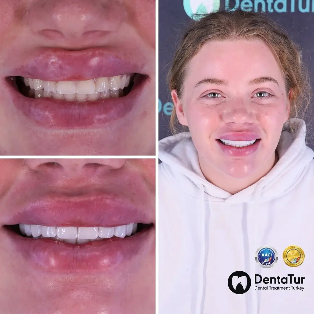 E-max veneers in Turkey before and after