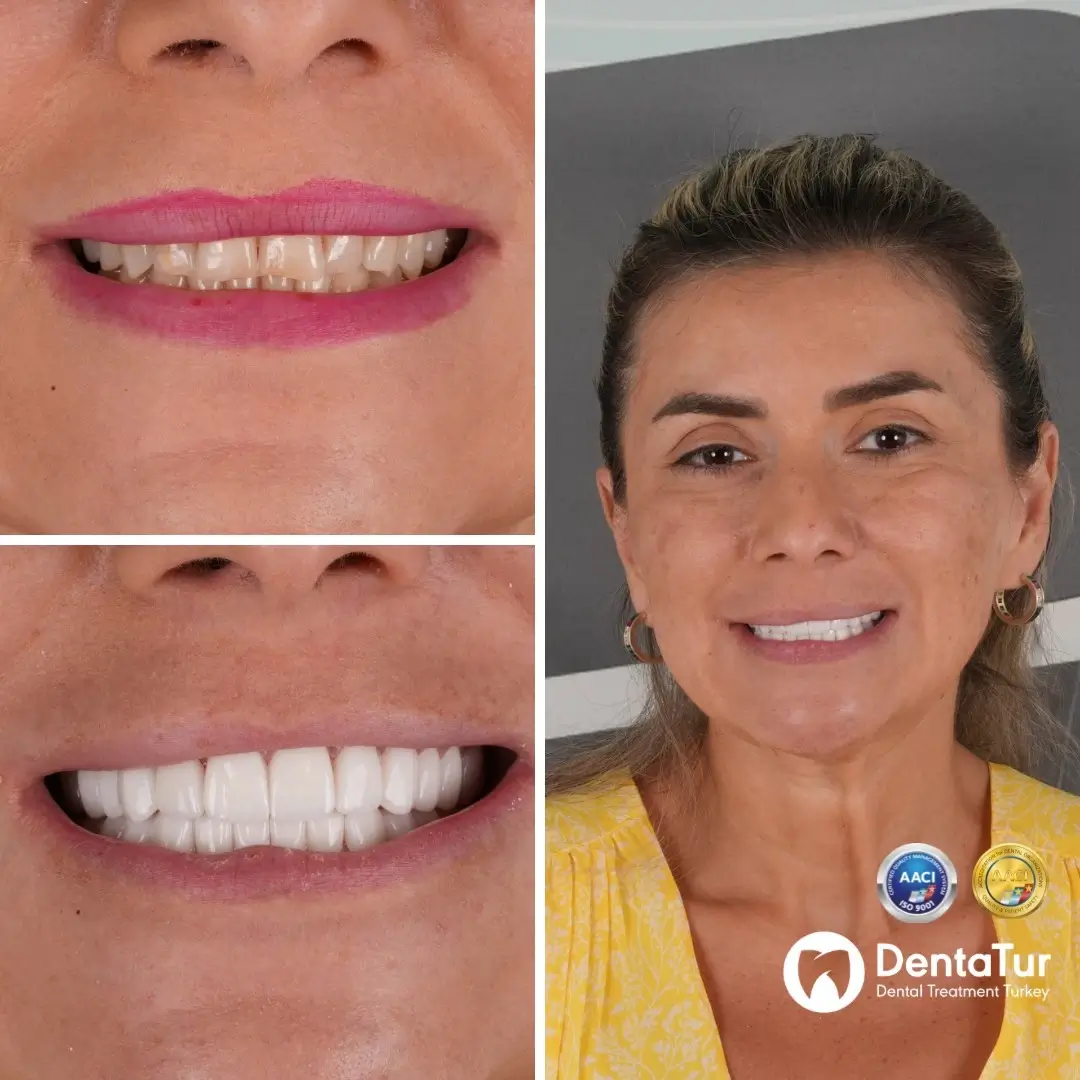 Turkey Teeth Bonding (Veneers): Alternative Treatments and Packages