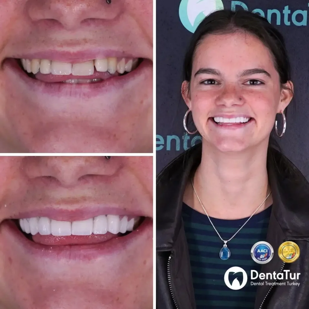 Zirconium veneers